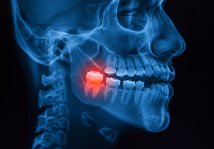 MUELA DEL JUICIO atención de urgencia dental en Concepción