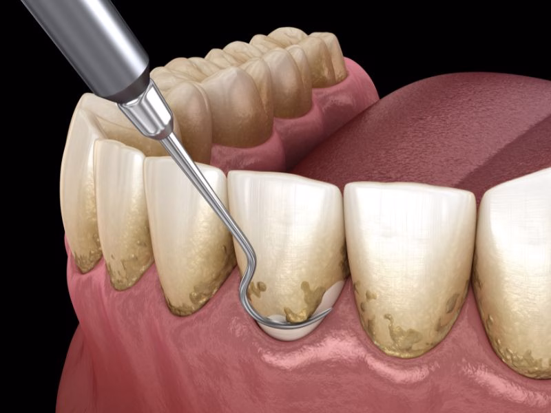 raspado y alisado radicular