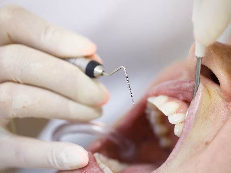 raspado y alisado radicular