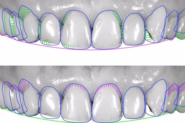 Diseño de sonrisa digital